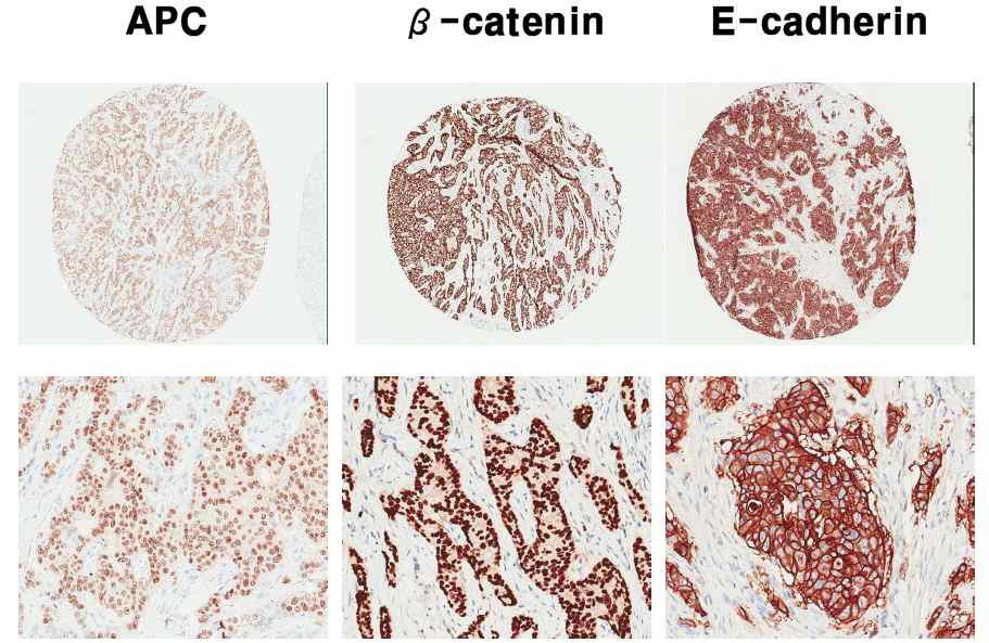 Immunohistochemical staining in tissue array samples of stomach cancer