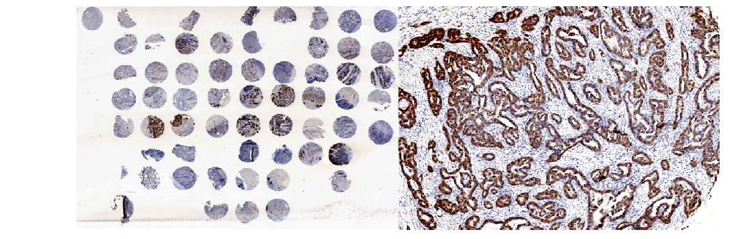 Stomach cancer tissue microarray composed of total 26 paired normal and cancer tissues. Left is a thumbnail and right is a cancer spot magnified by 50x. This array is stained with anti-p16 antibody