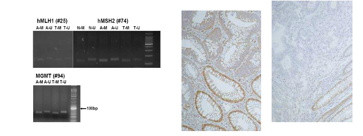 대장 샘종과 암종에서 MSP를 이용한 hMLH1, hMSH2 및 MGMT 유전자의 메틸화와 해당 조직의 hMLH1면역조직화학적 염색결과
