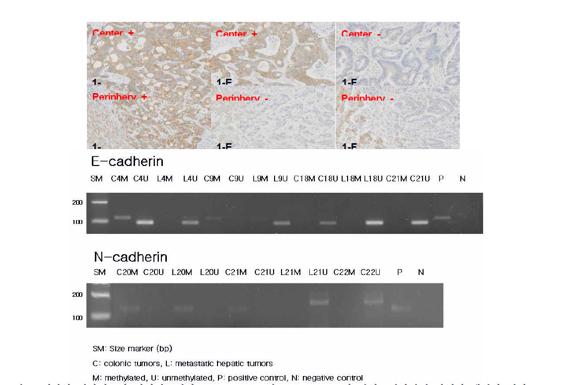 대장암 원발병소와 전이병소에서 E-cadherin 및 N-cadherin의 면역조직화학적 발현과 메틸화 결과