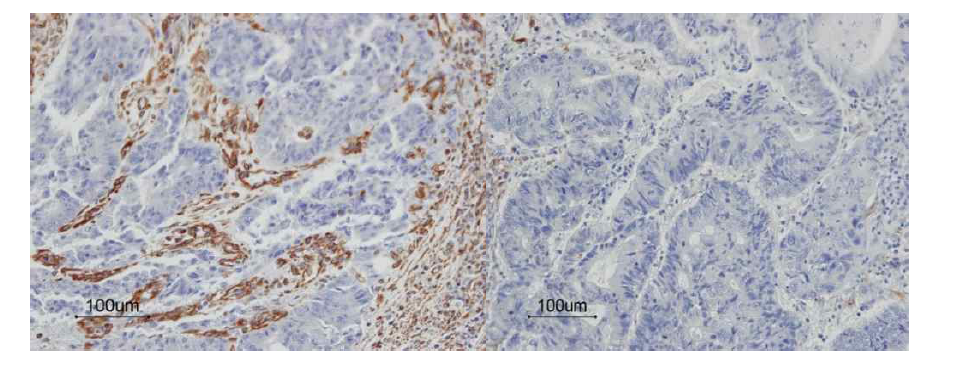 대장암에서 vimentin에 대한 면역조직염색 결과