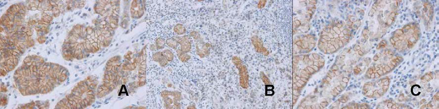 E-cadherin 단백질은 일반적으로 정상점막에서 발현이 잘 유지되는 것으로 알려져 있다 (Figure 2A). 그러나 유전자 프로모터에 메틸화를 동반한 다수의 증례에서 종양세포에서 발현이 억제되어 있었으며 (Figure 2B), 종양 주변의 정상점막에서도 일부 발현이 소실되어 있는 소견을 보여 (Figure 2C), 일부 종양 주 변 정상 점막에서는 종양으로 전환되지 않았더라도 E-cadherin이 소실되는 소견을 보이는 것을 확인할 수 있었 음