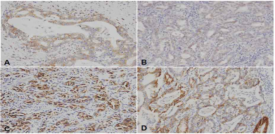 Immunohistochemical staining shows expression of ZEB1, and MUC1 in gastric cancer