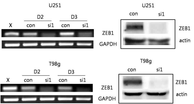 ZEB1 knockdown using siRNA in U251 and T98G cell lines, confimed by RT-PCR and western blot analysis