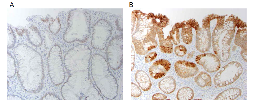 Immunoreactivity for CDX2 (A) was reduced in some (4/6), but not all, adenomas that showed CDX2 hypermethylation by array analysis. However, all six adenomas with CDX2 hypermethylation showed aberrant nuclear and/or cytoplasmic localization of beta-catenin (B)