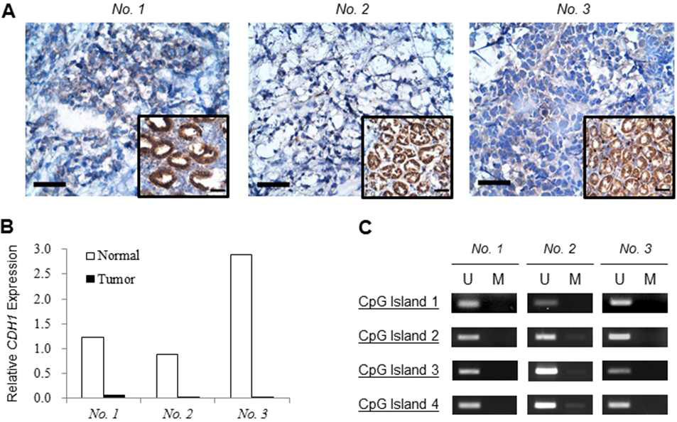 (A) Lack of E-cadherin expression in diffuse gastric cancer with no hypermethylation, compared to normal gastric mucosa (inlet). (B) Relative CDH1 expression normal to tumor tissue in early onset gastric cancer. (C), Representative examples of methylation analysis of E-cadherin gene in early onset gastric cancer. The PCR products of the lanes marked U show the presence of unmethylated templates of each gene, whereas the products in the lanes marked M indicated the presence of methylated templates