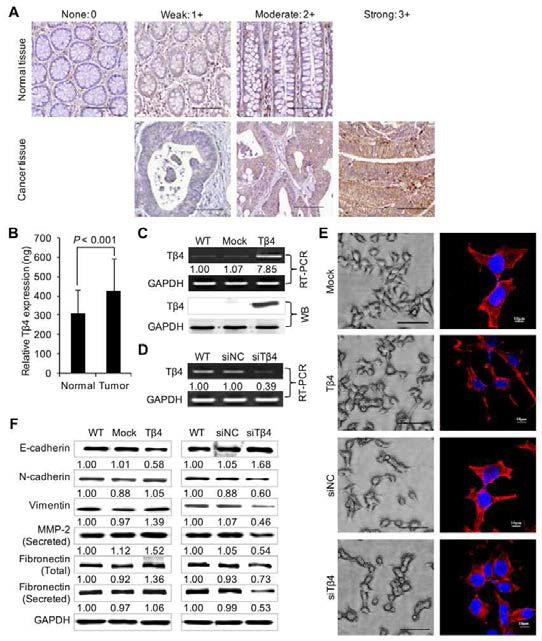 Tβ4 is colorectal cance r overecexlplsre. ssed (Ain) cRaenpcreers entaantidv e niomrmagael s toisfs uecso lorwecetrael =im m2u0n0o sμtamin. ed( Bw) itTh β4T βm4 RaNnAti boledvye.l sB ainr ctioslsoureesc tawl as camnceears ureadn d usinnogn cRanTc-erPoCuRs laenvde l noorfm a1l8izSe d rRaNgaAin. stV atlhuee s exreppreressseionnt bmye aan ss t±ab lSeD .T β(C4-) eTxβp4re swsainsg upplraesgmuildat eidn wCaecroe- 2m ecaeslulsr.e d Tβu4s inge xprReTss-ioPnC R levaenlds TWβe4s tern bmloRtNtinAg . (D)w Tash e exptrreasnssiioenn tolyf idno wnCraecgou-la2t edc eblyls a aTnβd4 -wspase cifmice assiRurNeAd fuosrinmga tionR Tw-aPsC Ro.b ser(vEe)d inP smeuodnooplaoydeiar cwuelrtuer e obotfa inCeadc o-un2d erc ellpsh. asPeh otcoognrtarpahsst Emliocnrogsacteodp y (alcetfitn)-. baBsear =ta ils2 00 wμemre. owbesreer vedo bbtayi nepdh allobidyi n sctoaninfioncga.l Imlaagseesr sμcma.n n(iFn)g Tmhicer oesxcporpeys si(ornig hlet)v.e lBs aor f =E M1T0 cmealrlsk ersw eirne Tβm4e auspu-re da ndu sdionwg nrWegeuslateternd blotting