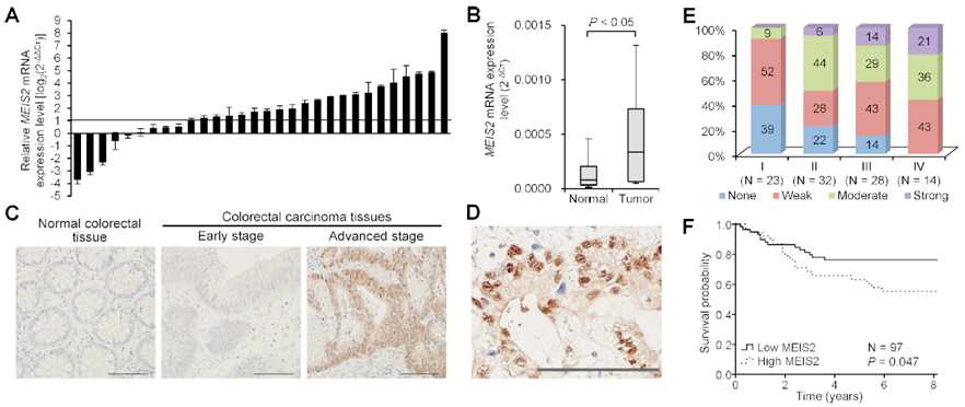 MEIS2 is frequently overexpressed in colorectal cancer cells and its tumoral high expression correlated with advanced stage and shorter survival of colorectal cancer patients