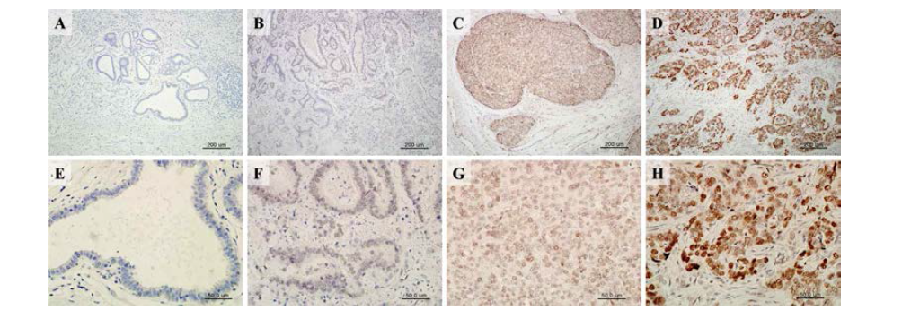 Representative images of HOXC9 immunohistochemical staining in human gastric carcinomas