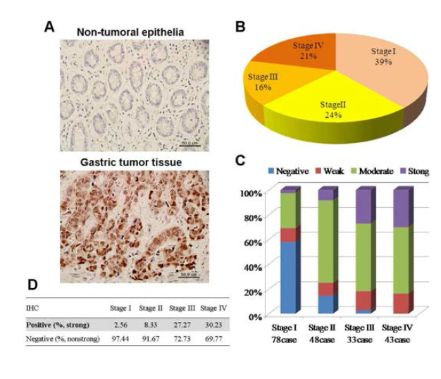 Immunohistochemical analyses of HOXC9 proten expression in gastric carcinomas