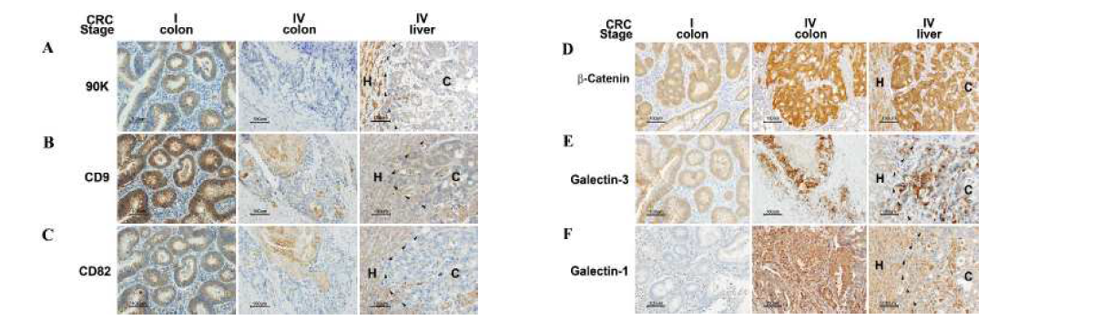 The expression of 90K, CD9, CD82, β-catenin and galectins in human colon and metastatic liver tissues. The expression of 90K (A), CD9 (B), CD82 (C), β-catenin (D), galectin-3 (E), and galectin-1 (F) was examined by immunohistochemistry (dark brown color) in serially sectioned human colon tissues from stage I and IV CRC patients and in metastatic liver tissues from stage IV. In metastatic liver tissues, invading colon cancer cells (C) and adjacent hepatic tissues (H) are demarcated by the dotted line. Scale bar: 100 μm