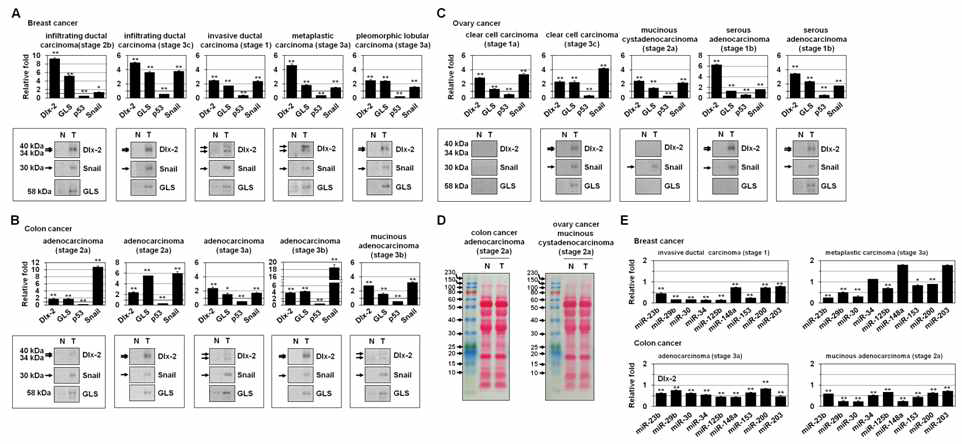 암조직에서 Dlx-2, GLS, p53, Snail, Snail-targeting miRNA 발현