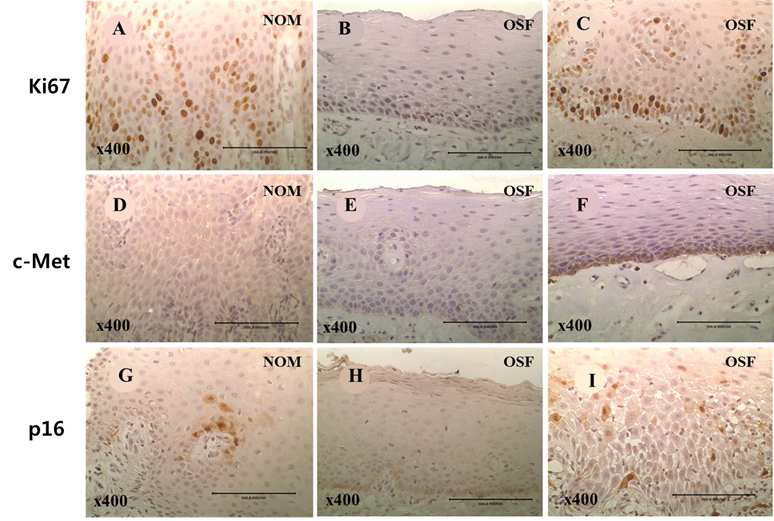 면역조직화학염색결과: 정상 점막 (A,D,G) 암으로 이행되지 않은 Oral submucous fibrosis (B,E,H), 암으로 이행된 oral submucous fibrosis (C,F,I)