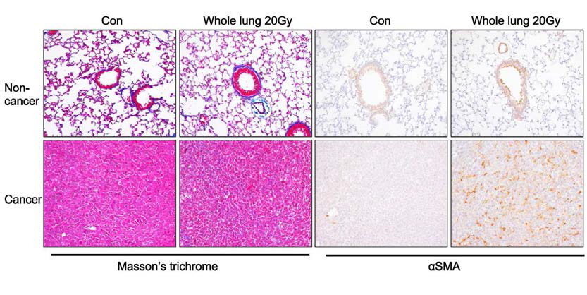 방사선 폐 전체 조사 후 정상 및 폐암조직에 대한 섬유화 영향