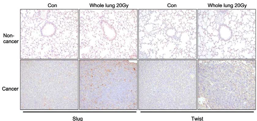 정상 폐 및 폐암조직에서에서 방사선 조사 후 EMT 신호 인자의 발현 분석