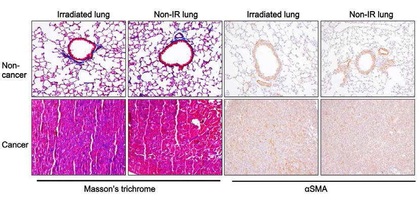 방사선 부분 조사 (half lung) 후 정상 및 폐암 조직에 대한 섬유화 영향