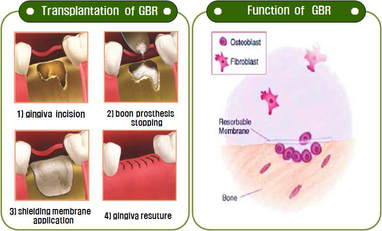 Principle of Guided Bone Regeneration (GBR).