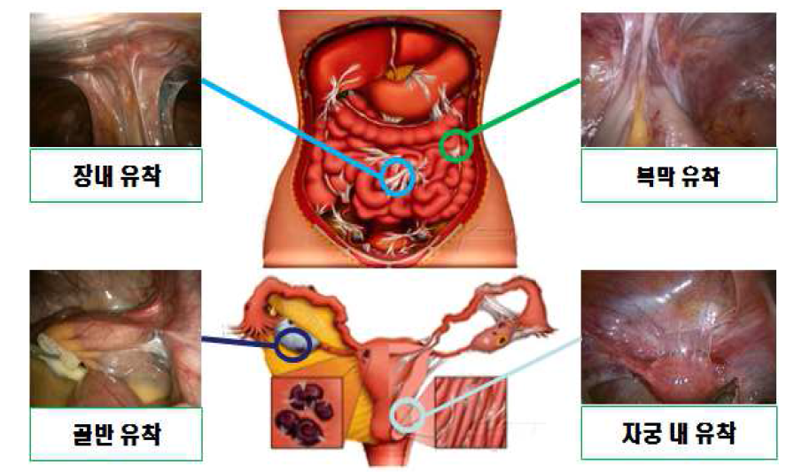 Various post-operative adhesions of human body.