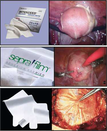 Membrane types of anti-adhesion barrier.