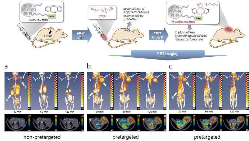 U87MG 종양모델에서 [18F]2의 PET/CT 영상(A)과 ADIBO-PEG-MSNs (100 μg) 나노입자를 주입한 후 24시간의 [18F]2을 pretargeting한 PET/CT 영상(B), ADIBO-PEG-MSNs (250 μg) 나노입자를 주입한 후 24시간의 [18F]2을 pretargeting한 PET/CT 영상(C)