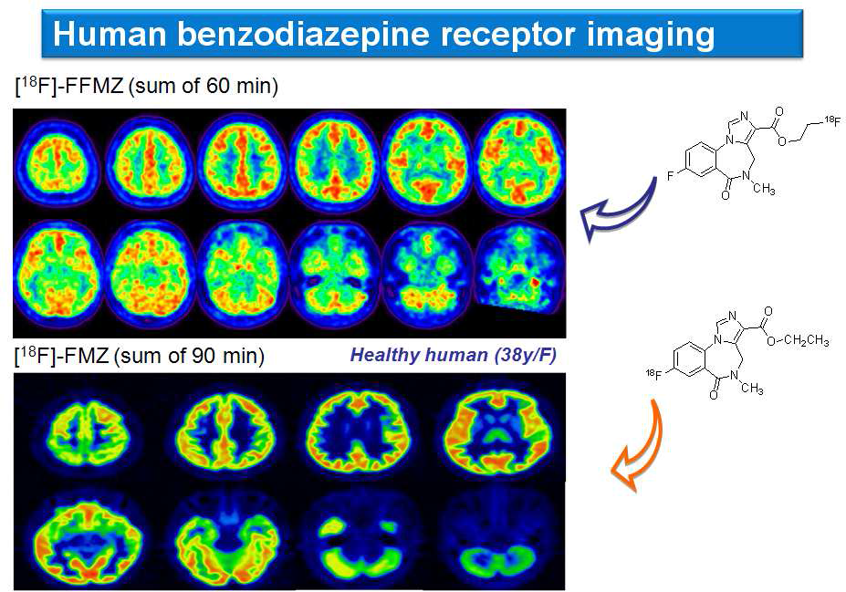 F-18 Fluoro Flumazenil([18F]FFMZ)와 F-18 Flumazenil([18F]FMZ) 비교 영상