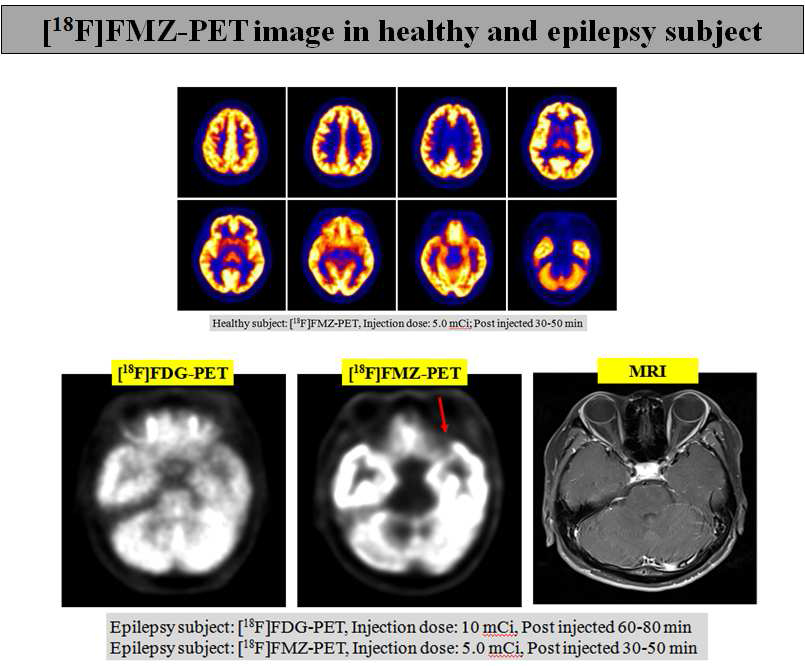 F-18 Flumazenil([18F]FMZ)의 정상 및 간질환자에서의 PET 영상