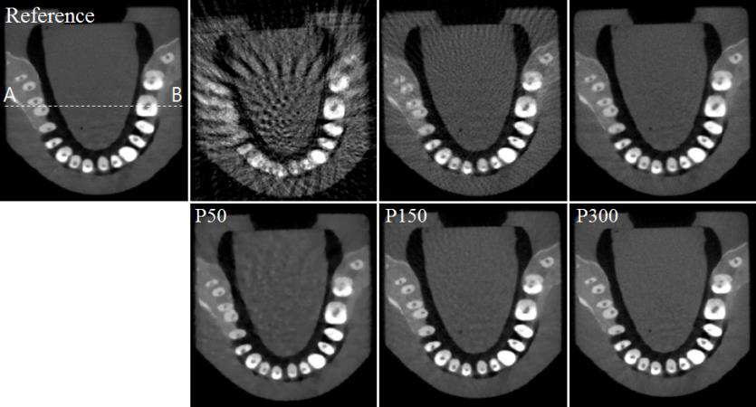 Sparse-view CBCT 스캔 구조일 때 재구성된 실험 영상: 치아 phantom (50, 150, 360 장)