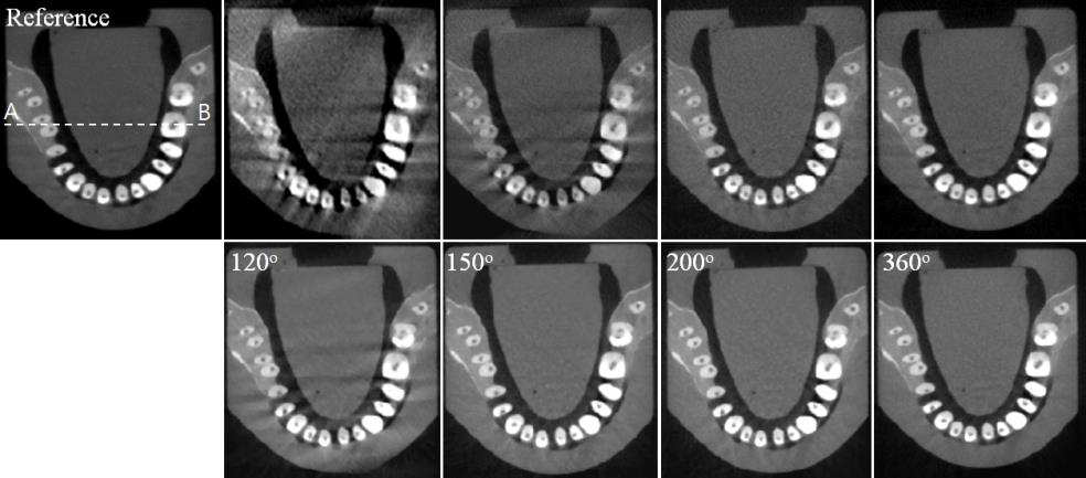 Limited-angle CBCT 스캔 구조일 때 재구성된 실험 영상: 치아 phantom(120o, 150o, 200o, 360o), FBP(상), CS(하)