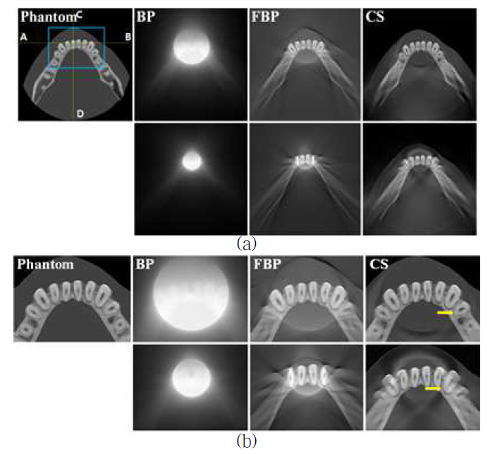(a) 360장 projection 데이터로 두 종류의 ROI 크기(중간 크기(28% coverage) 및 작은 크기(14% coverage))로 재구성한 CT 영상 결과와 (b) 그 확 대 영상: BP, FBP, CS