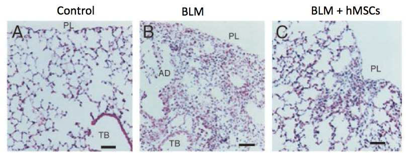 간엽줄기세포의 세포치료로 경감된 Bleomycin 에 의한 폐 섬유화