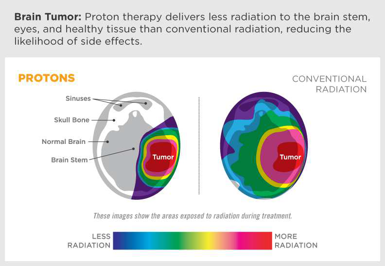 뇌종양 치료에서 정상 조직의 부작용을 최소화할 수 있는 양성자 기반 치료와 전통적인 X선 방식의 방사선 조사와의 정상 조직 손상 비교
