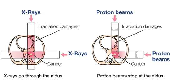 X선 3D-RT 와 양성자 치료의 비교