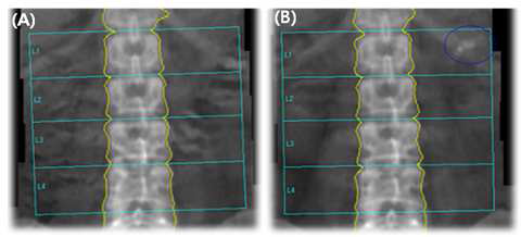 칼슘약제를 복용 하기 전과 후의 골밀도 영상으로 약제를 복용하기 전에는 보이지 않았던 L1의 연부조직영역과 Rib 선상의 인공물이(A) 약제를 복용한 후의 영상에서는 나타남(B)