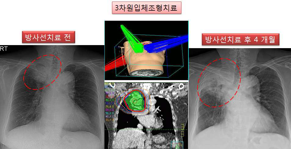 실제 임상 예 환자로 60 이시며, 방사선치료를 3 차원입체조형치료법으로 66 Gy 까지 시행하여, 우측 폐 상엽에 있던 종괴는 사라졌으나, 연이어 종양이 있던 부위 및 주변 정상조직에 심각한 기침 및 호흡곤란 증상을 동반한 방사선폐렴 발생을 상기 그림에 서 보여주고 있음.