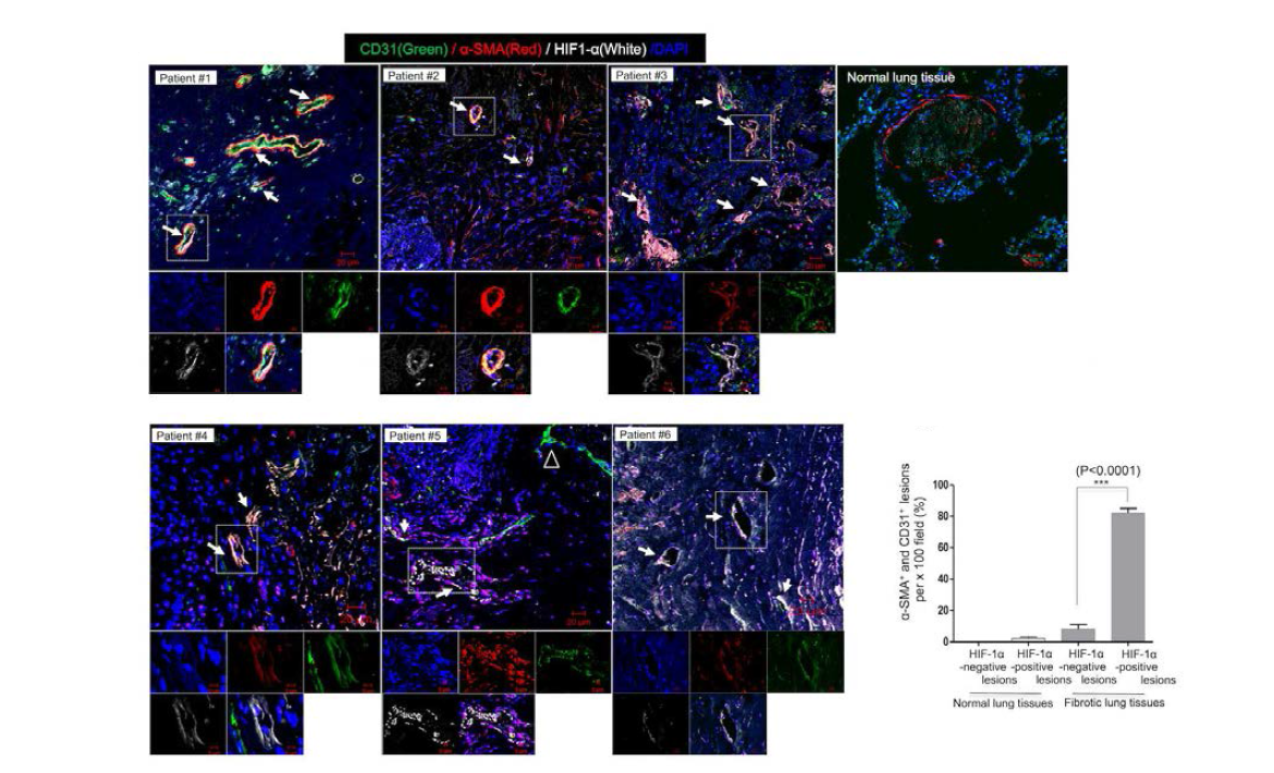 사람 폐섬유화 조직의 혈관내피세포에서 HIF-1α의 발현이 혈관내피세포의 간엽세포로의 전이 (EndMT) 현상과 관련이 있는지 알아보기 위해, 사람 폐섬유화조직을 HIF-1α (White), 혈관내피세포 마커인 CD31 (Green), 간엽세포 마커인 α-SMA (Red), 그리고 핵 염색제인 DAPI (Blue)로 형광 염색함.