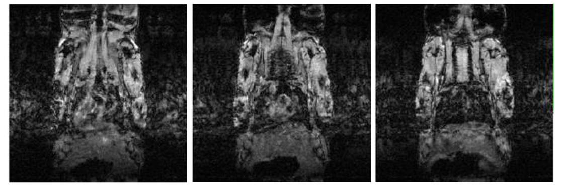 MRI 관찰시 호흡에 의한 artifact 및 어려움
