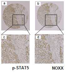 임상 유방암환자 조직에서의 p-STAT5와 NOXX의 발현 양상