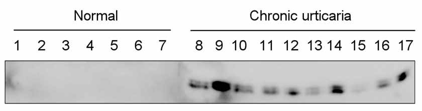 만성담마진 환자(chronic urticaria) 혈청에서 TCTP 검출