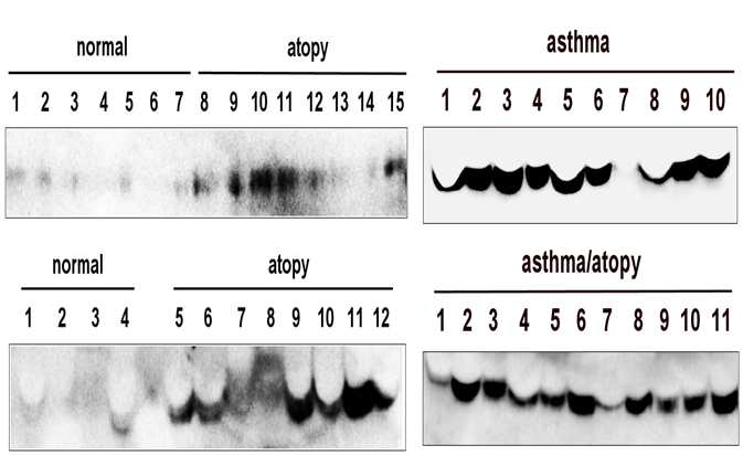 아토피피부염, 천식 환자에서 TCTP 검출
