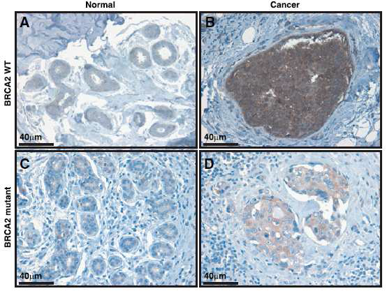 BRCA2 돌연변이를 동반하는 유방암 환자 조직에서 BubR1이 더 약하게 염색됨