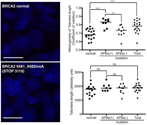 BRCA2 돌연변이를 동반하는 유방암 환자에서 관찰되는 텔로미어 길이의 heterogeneity 분석