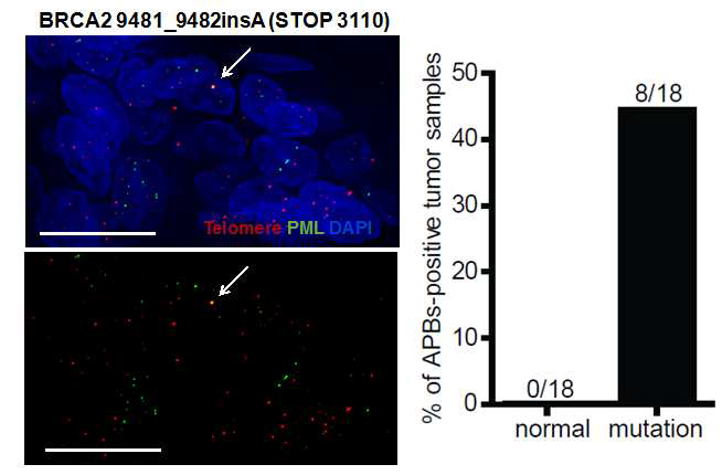 BRCA2 돌연변이를 동반하는 유방암 환자들에게서 관찰되는 APBs