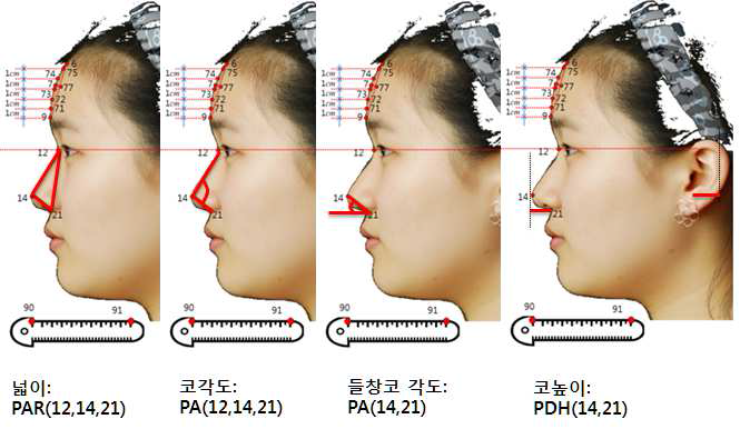 연관성이 확인된 측면 코 표현형