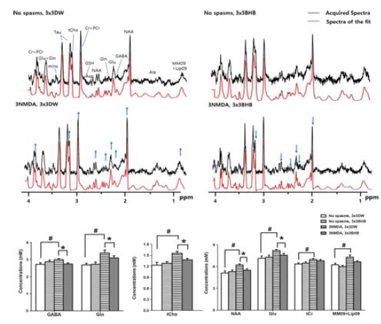 Examples of MR spectra and the mean differences of the analysed neurometabolites in each group of the rats with randomized BHB treatments or the controls. MRspectra are shown in the order of no spasms with 3 × 3 DW treatment, no spasms with 3 × 3 BHB treatment, 3NMDA spasms with 3 × 3 DW treatment, and 3NMDA spasmswith 3 × 3 BHB treatments. Significant elevations in the levels of GABA, glutamine, glutamate, total Choline, NAA, total creatine, and macromolecule and lipids after threebouts of NMDA-induced spasms (Student’s t-test, p < 0.05; # Significant difference between 3NMDA, 3 × 3 DW and No spasms, 3 × 3 DW group, blue arrow on the exampleof the spectra). Randomized BHB treatment significantly alleviated such elevation in the levels of neurotransmitters including GABA, glutamine, glutamate as well as NAAand total choline (*3NMDA, 3 × 3 DW vs. 3NMDA, 3 × 3 BHB group, blue arrow on the example of the spectra).