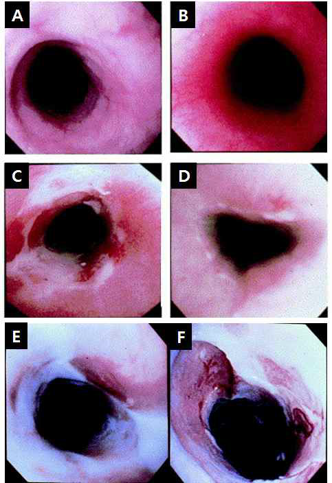 내시경으로 관찰한 방사선식도염.