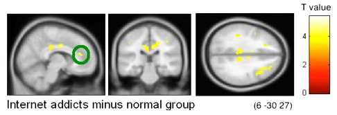 인터넷 중독 환자군이 정상군에 비해 ‘stroop-effect’ 과제와 관련한 영역 에서의 활성화가 높은 것으로 나타났고 이는 반응 억제 과정의 효율성이 떨어지는 것으로 볼 수 있음.