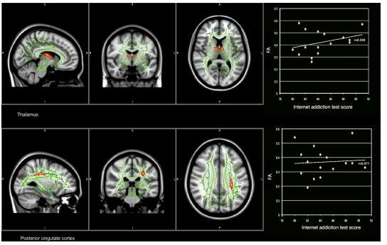 인터넷 중독 환자에게 나 타나는 뇌의 구조적 이상
