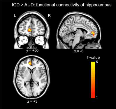 인터넷 중독군과 알코올 중독군 간에 Hippocampus와 기능적 연결성에서 차이를 보인 좌측 ventromedial prefrontal cortex.