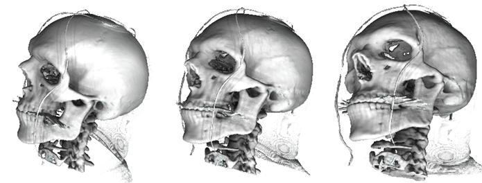 머리 CT데이터가 임의의 시점에서 정보가 가장 많은 부분으로 진화하는 과정을 보여주는 이미지들.