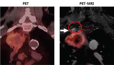 Warburg 효과의 진단적 가치와 한계. 활발히 분열하고 있는 암조직에서는 암세포의 aerobic glycolysis를 이용한 PET scan이 매우 효율적인 진단적 가치를 가지고 있으나, 일부 암, 전이성 암, 침윤성 암에서는 aerobic glycolysis가 감소하어 FDG uptake가 감소함 (흰색 화살표)(Am J Radiol 2009, 192:1012).